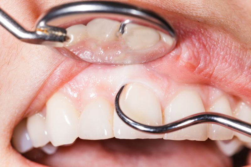 Ansicht vom Zahnfleisch ohne Zahnfleischentzündung
